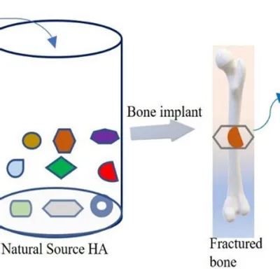 Hydroxyapatite Förstärkning Av Implantat Och Benregenerering!